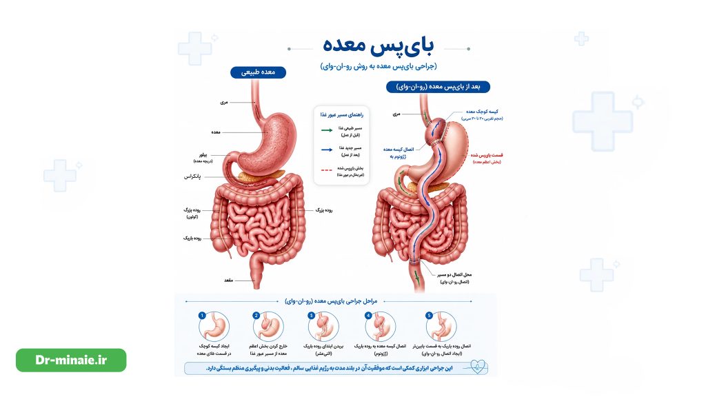 عمل بای پس معده